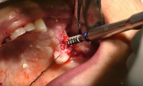 Corso 2: Tecnica Chirurgica Basale Pura e Inserimento Implantare